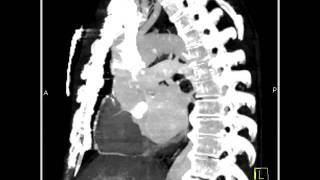 Cardiac Type B Dissection as well as Coronary Artery Disease 2 of 7 [upl. by Notnef195]