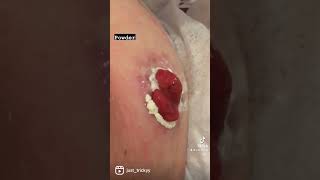 Stoma care ileostomy skin help [upl. by Denni311]