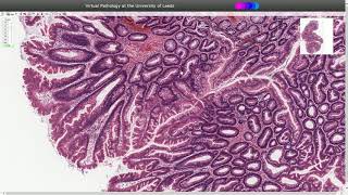 Traditional Serrated Adenoma  Histopathology [upl. by Gathers]