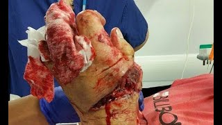 Paramotor Chops Fingers Off WARNING GRAPHIC [upl. by Keelia]