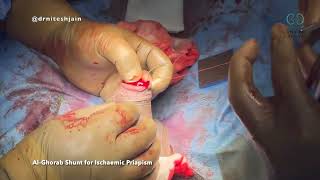 Al Ghorab Shunt for Ischaemic Priapism [upl. by Sukul]