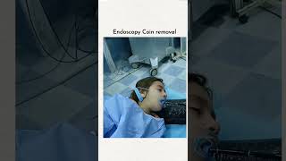 Endoscopy coin removel [upl. by Aislehc]