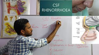 CSF RHINORRHEA  ENTNOSE [upl. by Ofori]