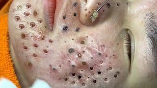 Loan Nguyen Acne Treatment 2245hn [upl. by Etnuhs]