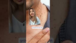 Effective Skin Tag Removal Methods Cryotherapy Surgery amp Electrosurgery Explained [upl. by Yenaj197]