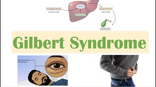 Gilbert Syndrome  Causes Genetics Pathogenesis Signs amp Symptoms Diagnosis Treatment [upl. by Bergeman]