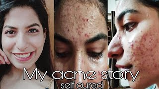 My pimple story Part 1 treatment and causes  How to reduce pimples and pimple scars  Acne [upl. by Kahler]