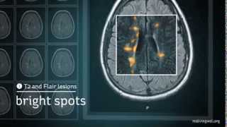 Multiple Sclerosis Understanding Your MRI [upl. by Ube]