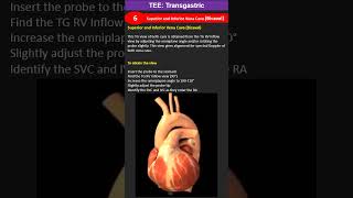 TEE Transgastric Superior and Inferior Vena Cava Bicaval [upl. by Annhej]