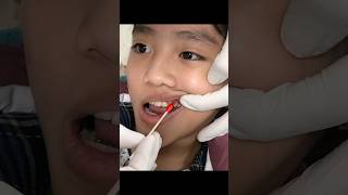 baby tooth extraction [upl. by Murage608]