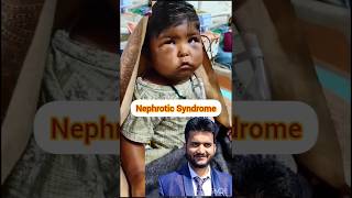 Nephrotic Syndrome shorts pna1 [upl. by Esinwahs]