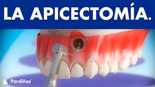 Apicectomía  Tratamiento infección de la raíz del diente © [upl. by Randolf]