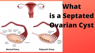 What is a Septated Ovarian Cyst [upl. by Kirst]