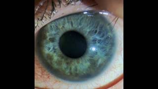 Uncontrolled IOP in an Eye with a Ciliary Body Melanoma 4 Months after Brachytherapy [upl. by Neelhtak]