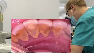 Remove tartar  teeth cleaning duet scaling [upl. by Lambrecht469]