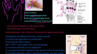 93P What is Rheumatoid Arthritis RA morphology prevalence pannus Rheumatoid nodules [upl. by Sparkie]