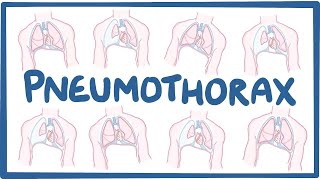 Pneumothorax  causes symptoms diagnosis treatment pathology [upl. by Artimed]