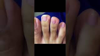 Ingrown toenail removal with Pedicure Knife Cut it easily Ep417 [upl. by Cristabel]