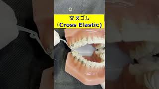 交叉ゴムのかけ方Cross elastic for improving scissors bite [upl. by Nahtannoj]