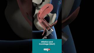 Dilation And Curettage DampC  Fertility Treatment ↪3D Medical Animation Shorts DilationampCurettage [upl. by Rothstein]