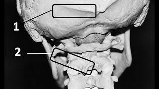 What is Occiptial Neuralgia [upl. by Llecram]