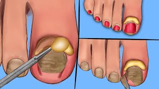 ASMR Cleanly Treat Old Ingrown Toenailsand Pus Toenails Scaling Animation Deep Clean Treatment [upl. by Niall]