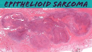 Epithelioid Sarcoma dont confuse with rheumatoid nodule or granuloma annulare Oregon Case 10 [upl. by Modie]