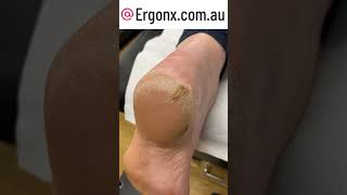 Painful cracked heel removal in the clinic [upl. by Yrtsed]