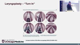 Management of Anterior Glottic Web Dr Brandon Jackson Baird [upl. by Tamma498]