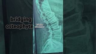 Ankylosing spondylitisBechtrewe’s diseaseAxial Spondyloarthritis xray video ultraradiology [upl. by Erikson]