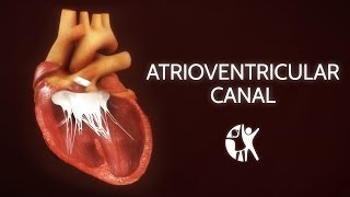 Atrioventricular Septal Defect  AV Canal [upl. by Aihsoek]