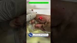 Pyogenic granuloma laser treatment  red bump on sole  pyogenic granuloma का इलाज़ Dr Uttam Lenka [upl. by Sedicla]