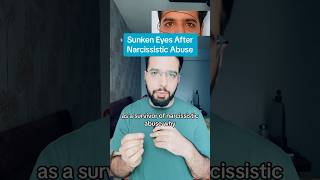 Sunken Eyes After Narcissistic Abuse narcissism [upl. by Orwin]