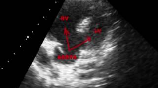 TETRALOGY OF FALLOT TOF  ECHOCARDIOGRAPHY SERIES BY DR ANKUR K CHAUDHARI [upl. by Theurich]