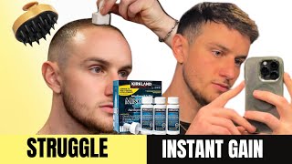 Why Minoxidil Derma Roller  Rosemary  Hair Transplant Soon [upl. by Deibel]