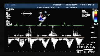 Hot Tips  Calculating the Aortic Valve Area Using the Continuity Equation [upl. by Niamjneb424]