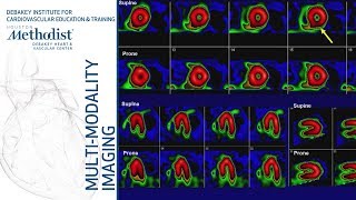 Nuclear Cardiology Understanding the Basics John J Mahmarian MD October 16 2018 [upl. by Trumann]