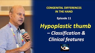 Congenital hand Episode 11  Hypoplastic Thumb  Classification and Clinical features [upl. by Yznel]