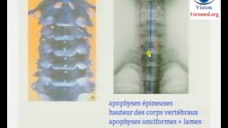 Traumatisme du rachis cervical symptôme diagnostic les Vertèbres cervicales bloquées [upl. by Noed]