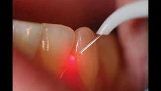 laser treatment for gum disease [upl. by Aufa85]