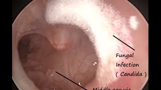 Otoendoscopy  Fungal Infection  Otomycosis  in left ear with subtotal ear drum perforation [upl. by Aiht709]