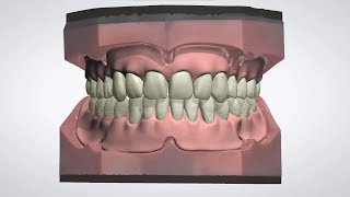 3Shape Dental System  Full Denture Design [upl. by Nixon774]