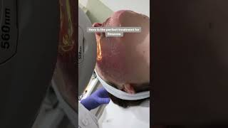 IPL treatment for Rosacea at Dermasurge Clinic Harley Street London  Dr Injibar [upl. by Patrizia405]