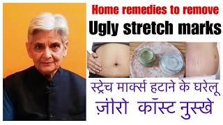 How to remove stretch markshome remedy to cure stretch marksस्ट्रेच मार्क्स हटाने के घरेलू नुस्खे [upl. by Cleodal]