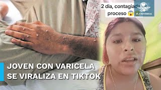 Joven se viraliza tras confundir viruela del mono con varicela [upl. by Hsital]