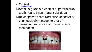 supernumerary teeth [upl. by Uol]