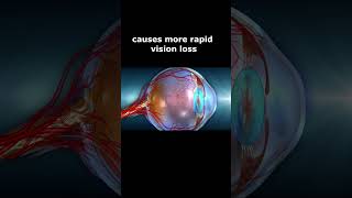 Hereditary Optic Nerve Disorders [upl. by Nwadal]