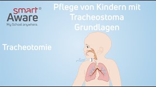 Pflege von Kindern mit Tracheostoma Tracheotomie  Pflegestandards Kinderkrankenpflege  smartAware [upl. by Tuinenga749]