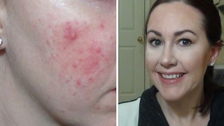 Foundation Routine Rosacea Extreme Redness Acne [upl. by Nnylarat]