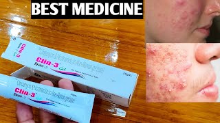 Clin 3 Gel Unboxing amp Review  चेहरा साफ करने और मुंहासे हटाने की Best दवा  Best Cream for Pimple [upl. by Ojaras212]